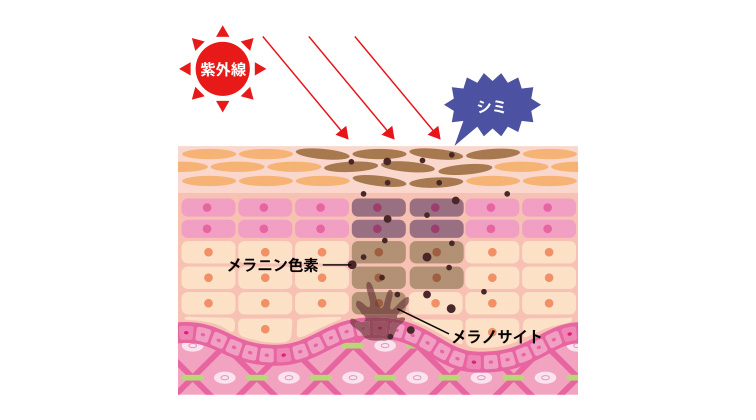 シミ治療とは